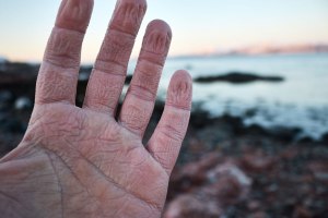 Martins hands after a day in his gloves